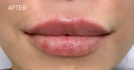 Restylane Kysse Before & After Patient #9268