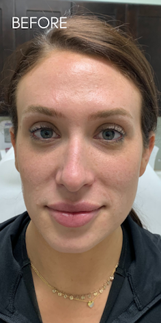 Restylane Lyft Before & After Patient #9271