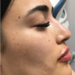 Restylane Lyft Before & After Patient #9277