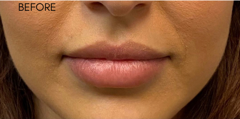 Defyne Before & After Patient #9280