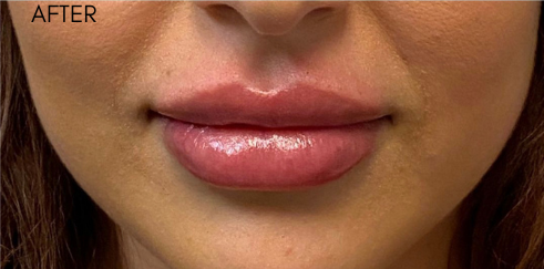 Defyne Before & After Patient #9280