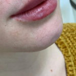 Restylane Kysse Before & After Patient #9283