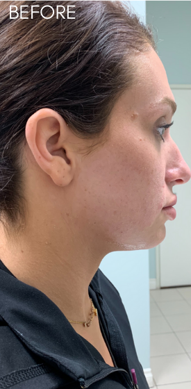 Restylane Lyft Before & After Patient #9286