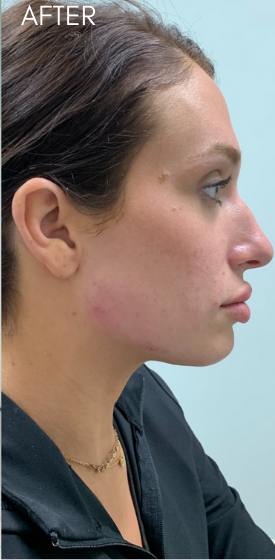 Restylane Lyft Before & After Patient #9286