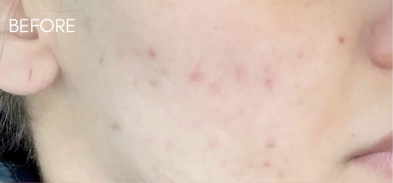Chemical Peel Before & After Patient #9289