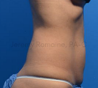 CoolSculpting Elite Before & After Patient #9572