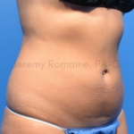 Fat Reduction Before & After Patient #9598