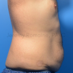 Fat Reduction Before & After Patient #9606