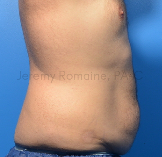 Fat Reduction Before & After Patient #9606