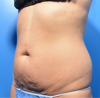 CoolSculpting Elite Before & After Patient #9609