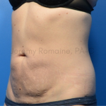 Fat Reduction Before & After Patient #9609