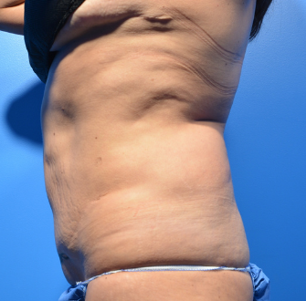 CoolSculpting Elite Before & After Patient #9612