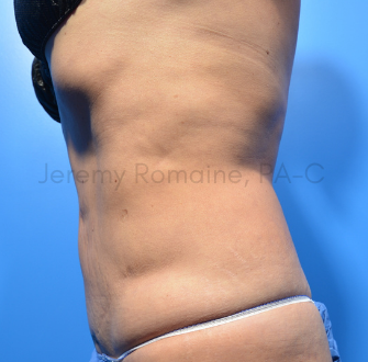 CoolSculpting Elite Before & After Patient #9612