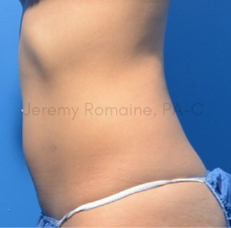 CoolSculpting Elite Before & After Patient #9615