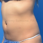 Fat Reduction Before & After Patient #9615