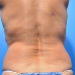 Fat Reduction Before & After Patient #9621
