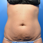 Fat Reduction Before & After Patient #9625