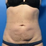 Fat Reduction Before & After Patient #9625