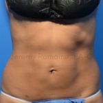 Fat Reduction Before & After Patient #9575