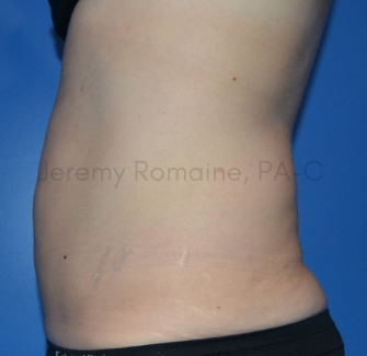 Fat Reduction Before & After Patient #9582