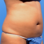 Fat Reduction Before & After Patient #9586