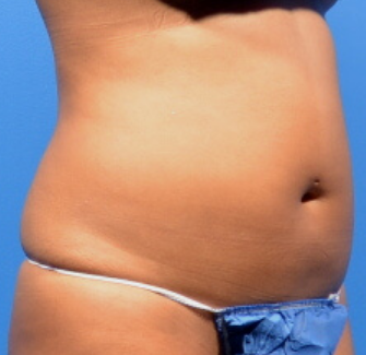 CoolSculpting Elite Before & After Patient #9586