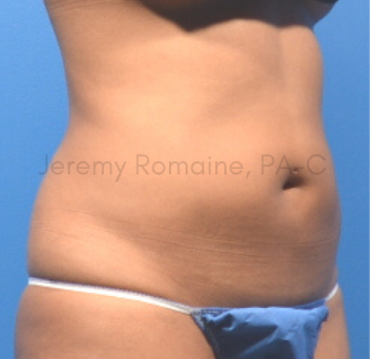 CoolSculpting Elite Before & After Patient #9586