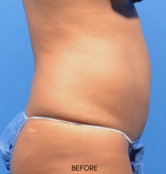 Fat Reduction Before & After Patient #9590