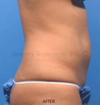 CoolSculpting Elite Before & After Patient #9590