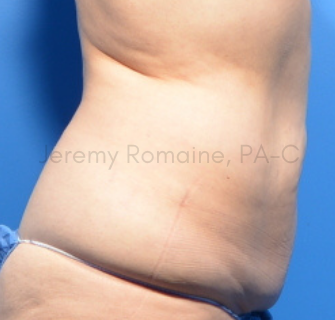 CoolSculpting Elite Before & After Patient #9593