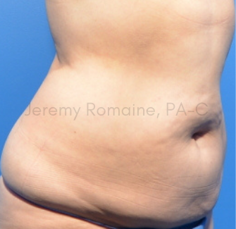 Fat Reduction Before & After Patient #9593