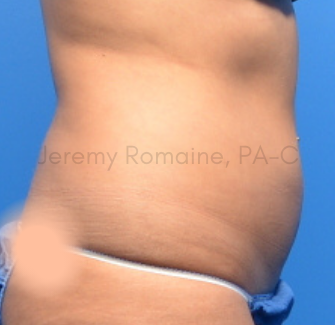 Fat Reduction Before & After Patient #9598