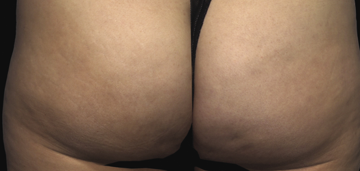 Qwo Before & After Patient #10002
