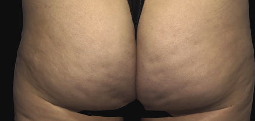 Qwo Before & After Patient #10002