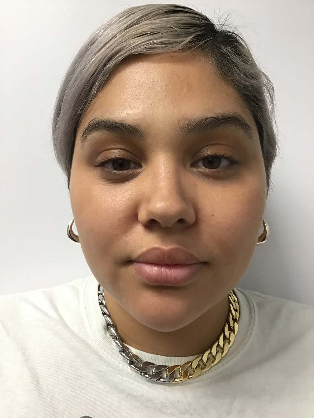 Restylane Before & After Patient #11022