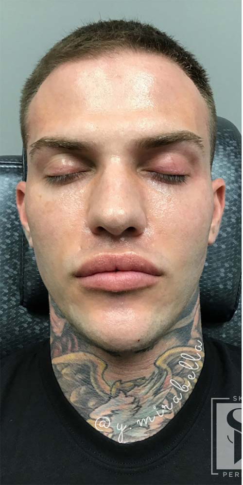 Radiesse Before & After Patient #10975