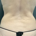 CoolSculpting Before & After Patient #10896