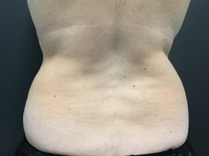 CoolSculpting Before & After Patient #10896