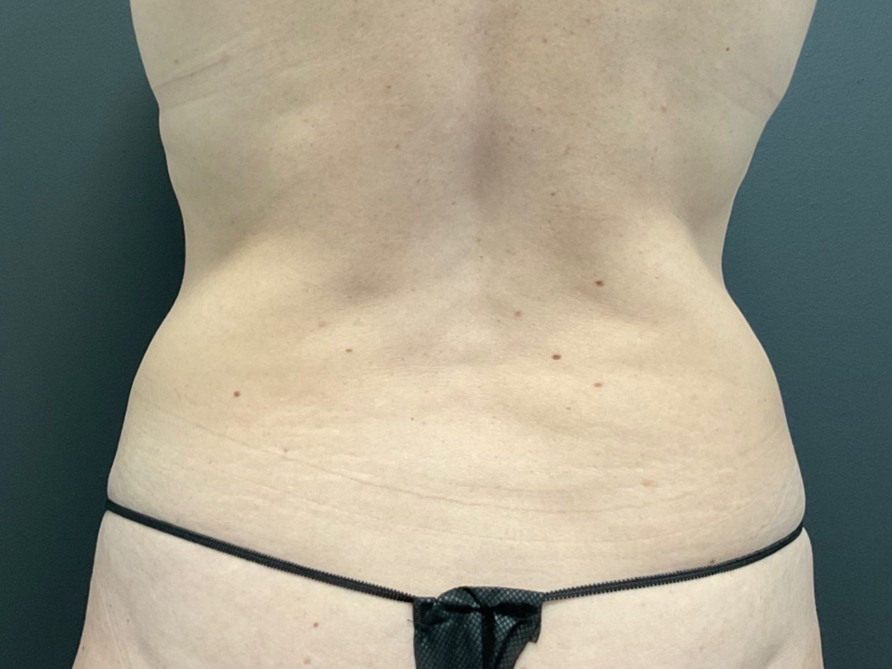 CoolSculpting Before & After Patient #10896