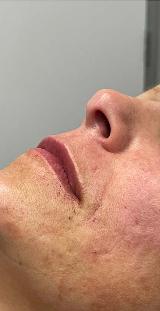 Restylane Before & After Patient #10996