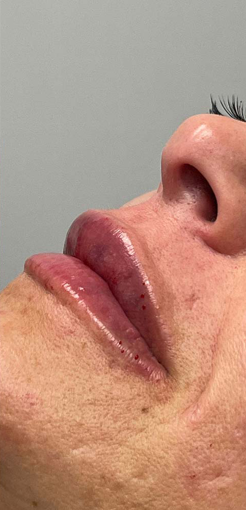 Restylane Before & After Patient #10996