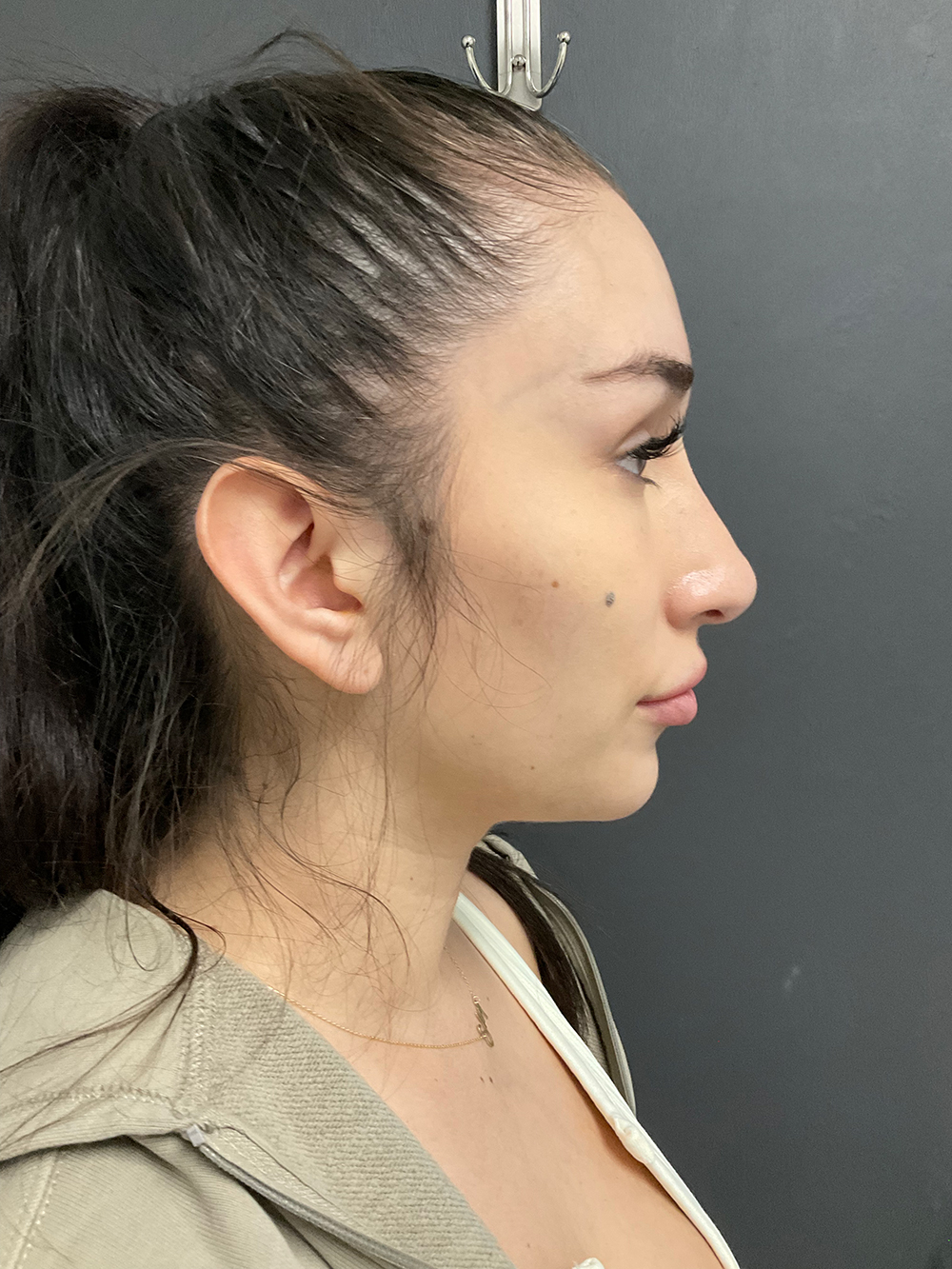 Non-surgical Nose Job Before & After Patient #10967