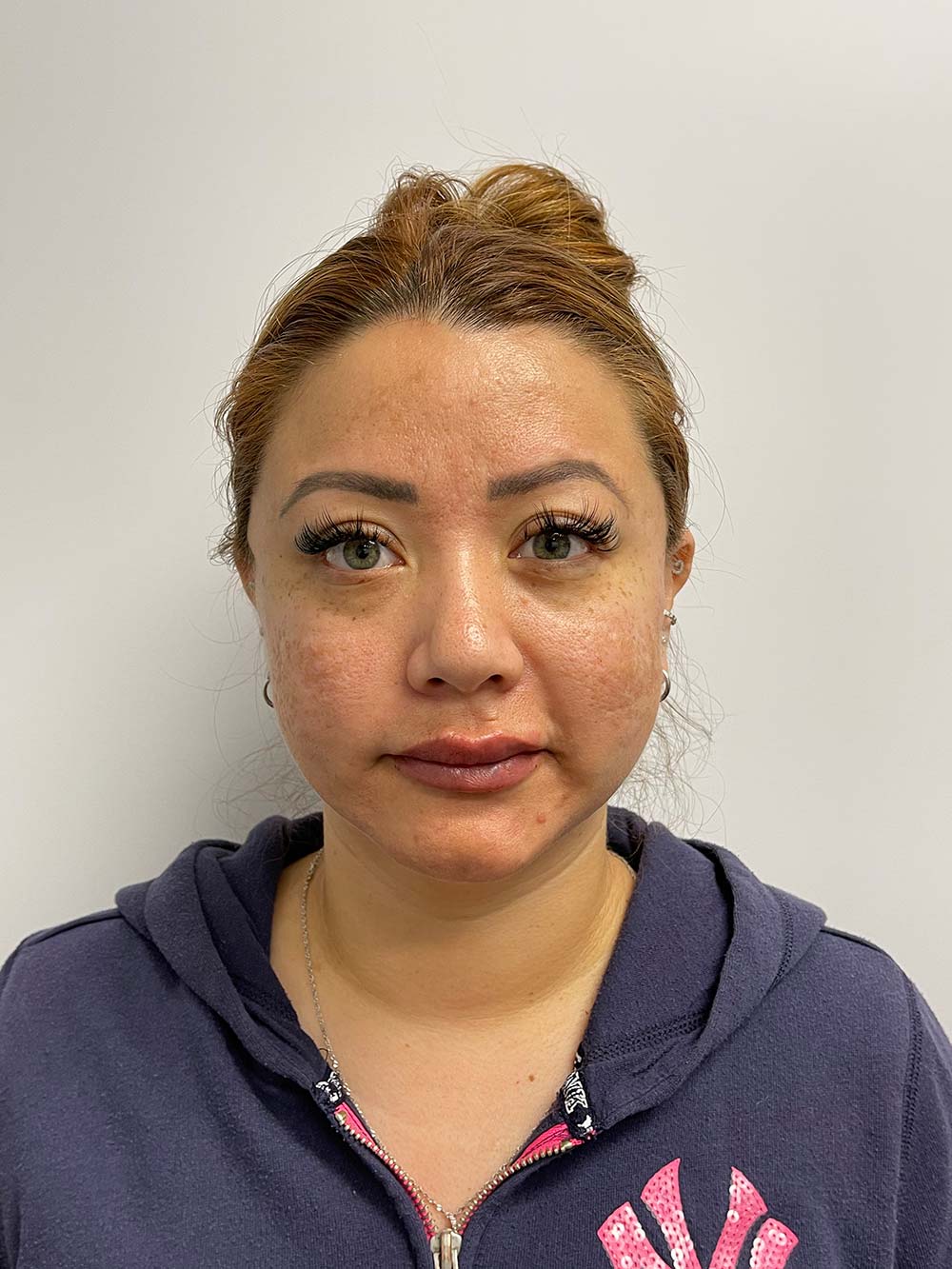 Thread Lift Before & After Patient #11066