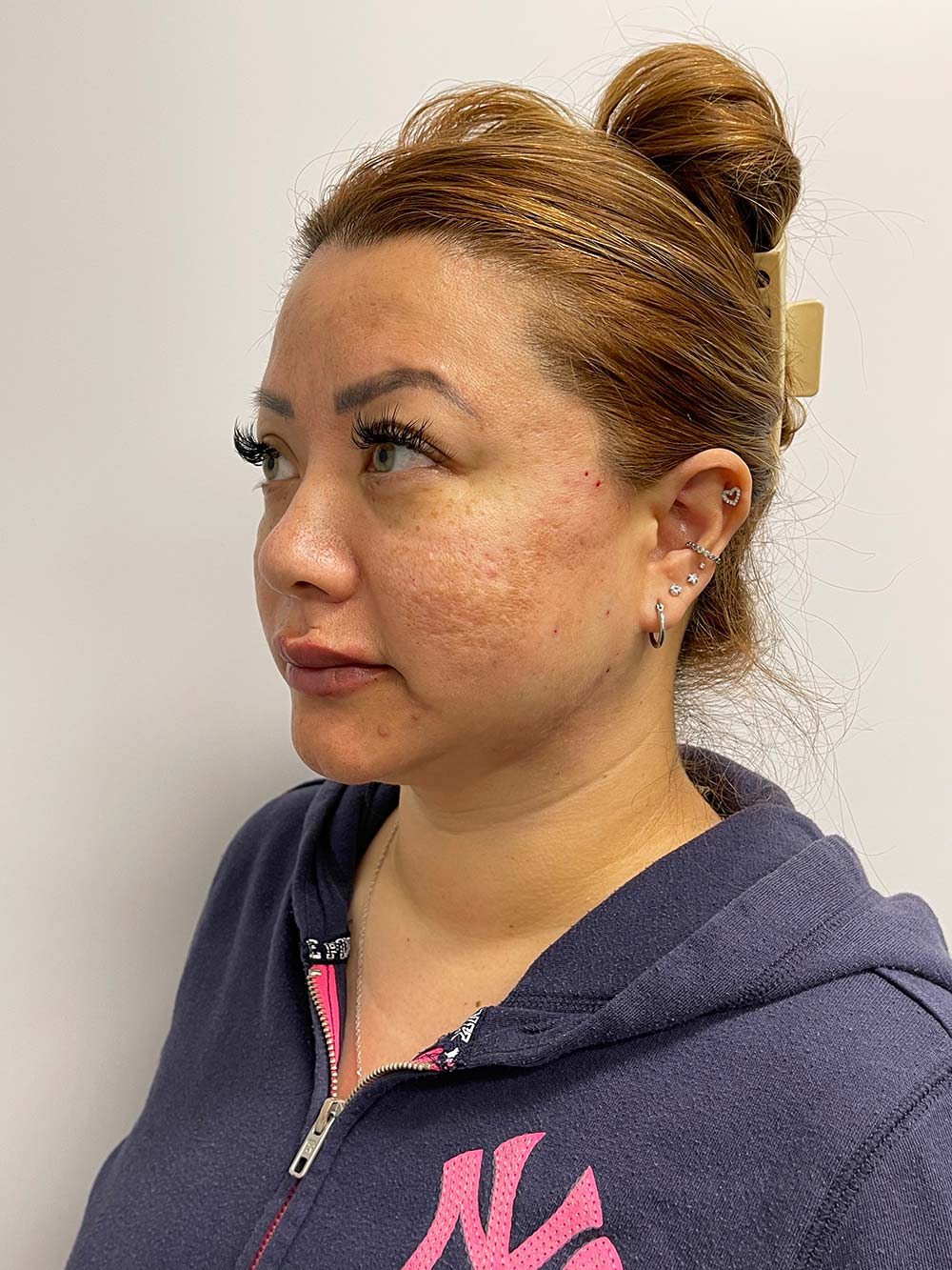 Thread Lift Before & After Patient #11067