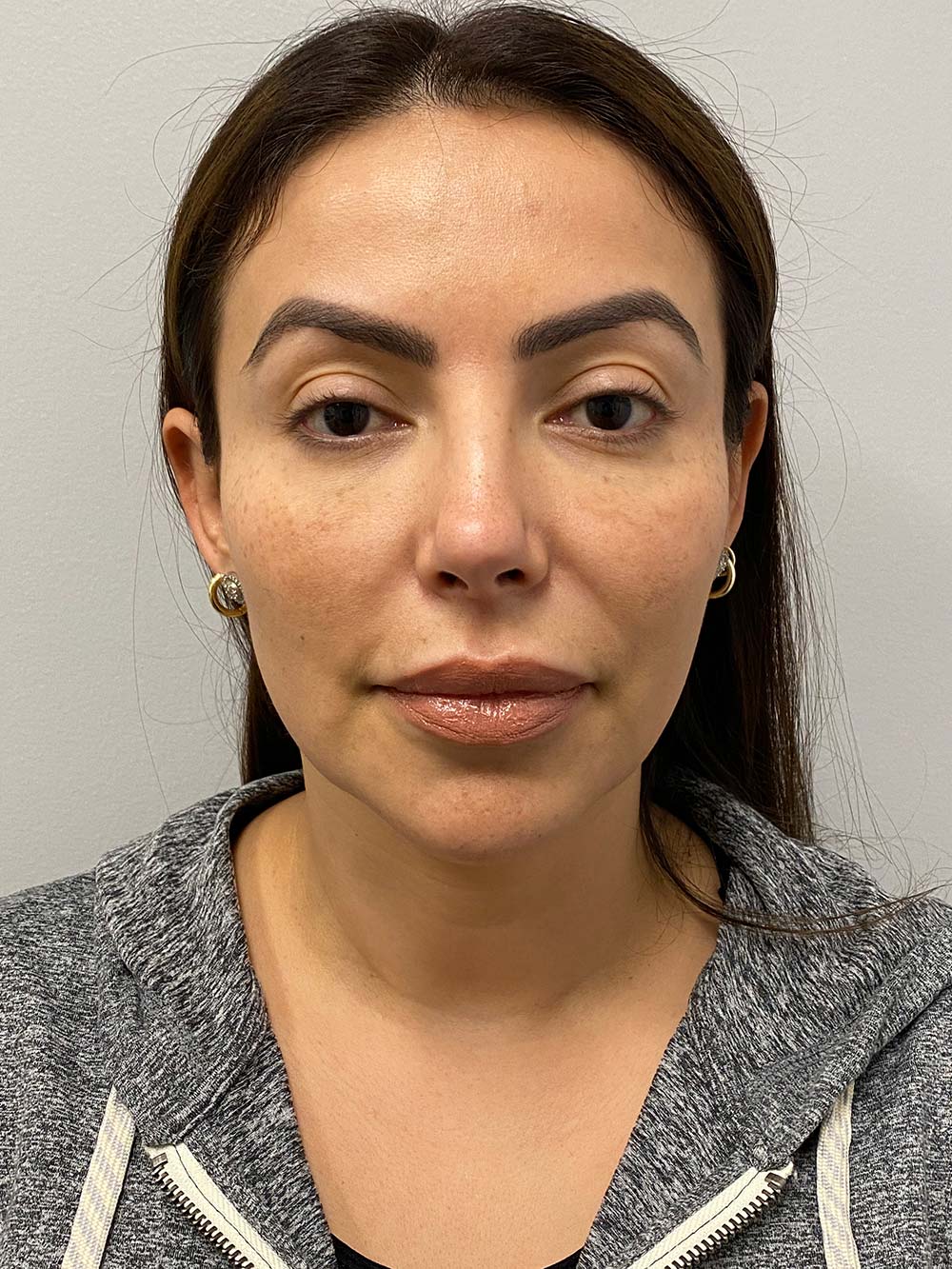 Radiesse Before & After Patient #10991