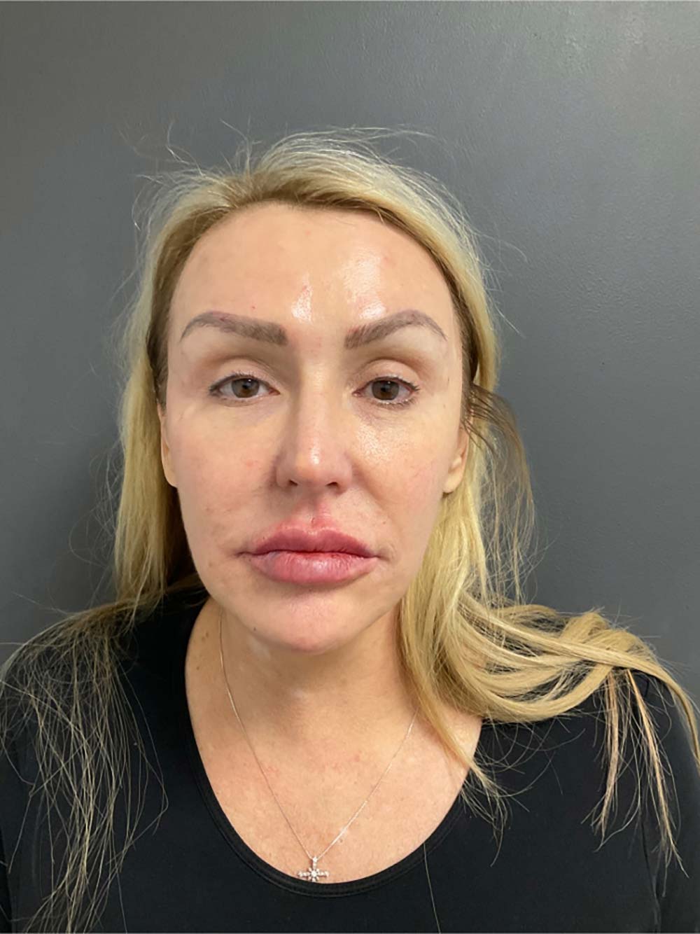 Restylane Before & After Patient #11019