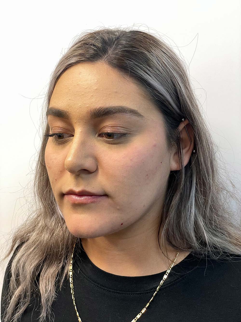 Radiesse Before & After Patient #10992