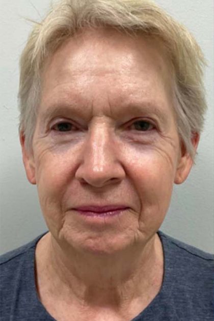 Botox, Dysport, & Xeomin Before & After Patient #10966