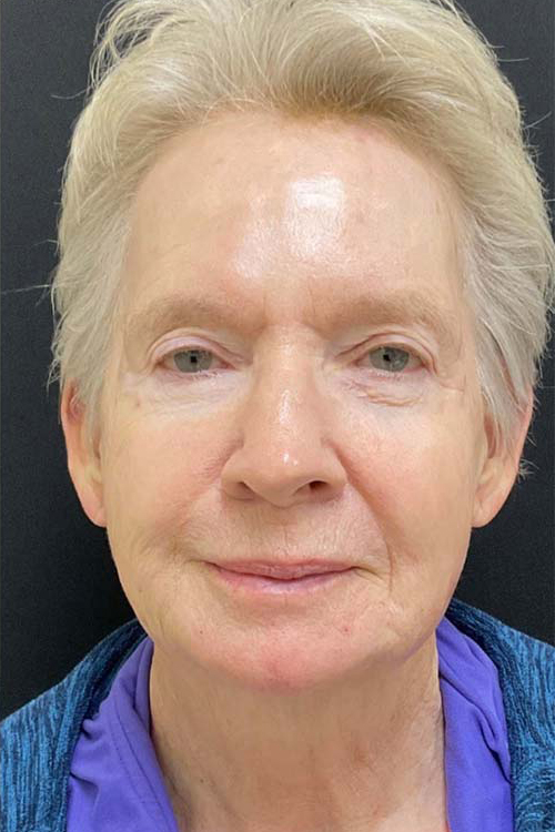 Botox, Dysport, & Xeomin Before & After Patient #10966