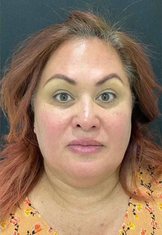 Botox, Dysport, & Xeomin Before & After Patient #10963